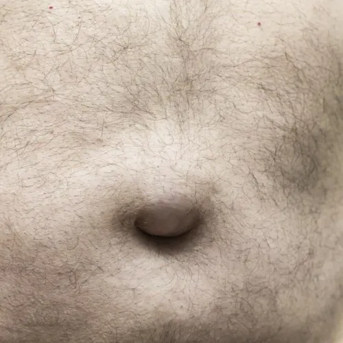 Umbilical Hernia Surgery  service image